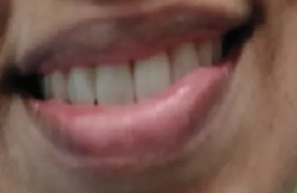 After treatment - case7