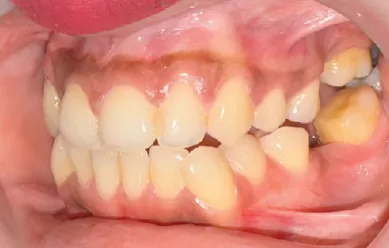 Before treatment - case 4