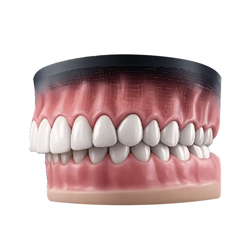 Overbite